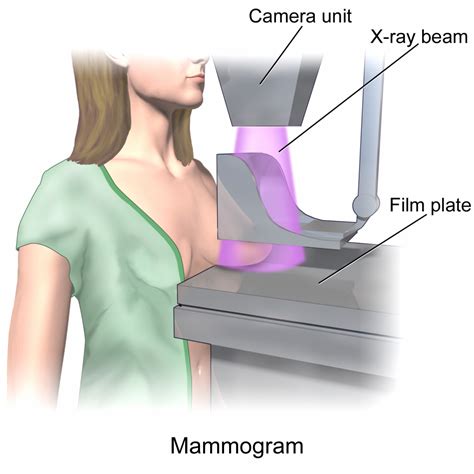 Mammography – Undergraduate Diagnostic Imaging Fundamentals