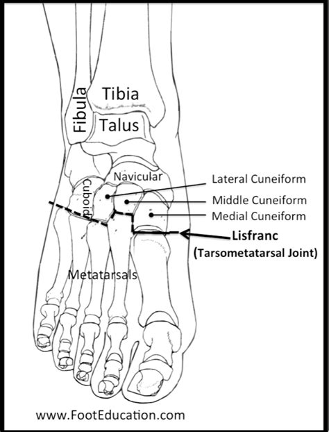 Lisfranc Fracture ORIF - FootEducation