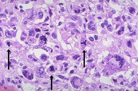 Anaplasia | Pathology Student