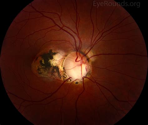 Atlas Entry - Optic nerve coloboma with peripapillary choroidal neovascular membrane