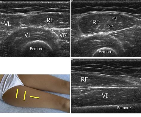 Quad Tendon Ultrasound