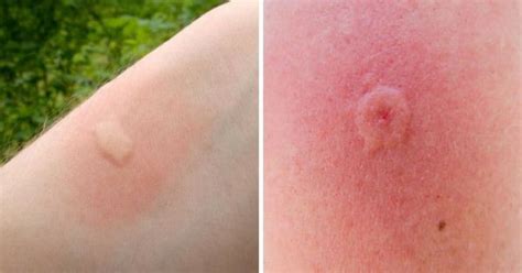 12 Common Bug Bites And How To Recognize Each One | Insect bites, Bug bites, Ant bites