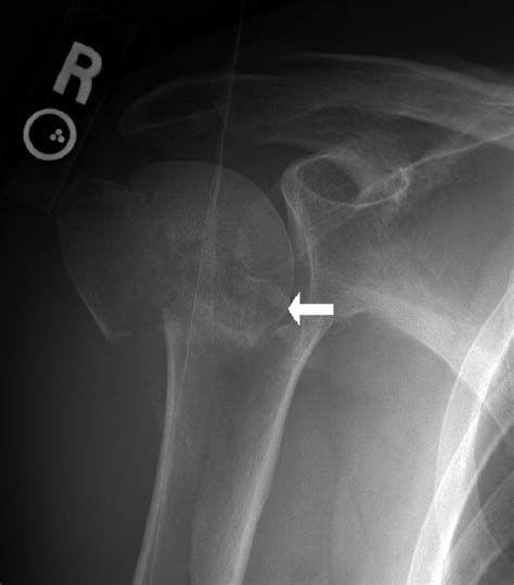 Proximal Humerus Fractures and Shoulder Dislocations | Radiology Key