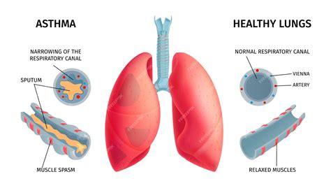 Premium Vector | Human lung anatomy respiratory asthma disease symptoms medical educative ...