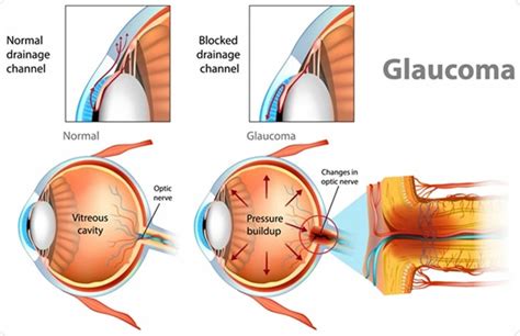 Peripheral vision, causes of peripheral vision problems & treatment