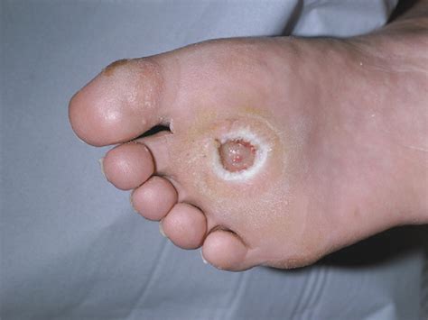 Diabetic foot ulcers - The Lancet