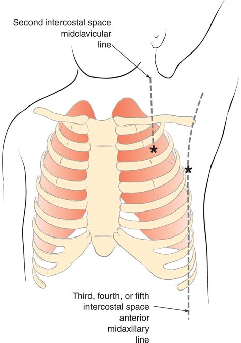 Tube Thoracostomy | Anesthesia Key