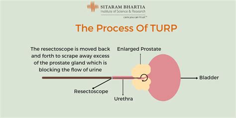 turp | Sitaram Bhartia Institute of Science and Research