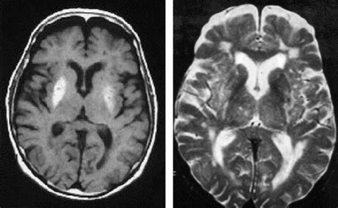 Hemiballism: revisiting a classic disorder - The Lancet Neurology