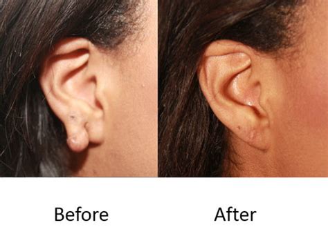 Keloid Scars in The Woodlands, TX | Dr. Guy Facial Plastic Surgery