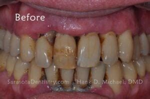 Black Tartar on Teeth: Symptoms and Treatment Options - Sarasota Dentistry