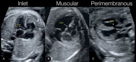 Fetal echo types of ventricular septal defects – SujyotHeartClinic