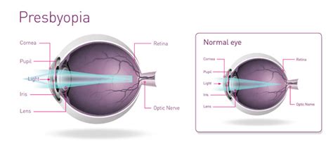 LASIK/LASEK in Seoul, Korea: Presbyopia Surgery Center at Kangnam ...