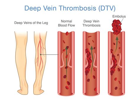 Acute Deep Vein Thrombosis (DVT)