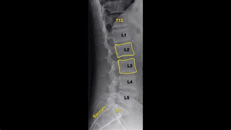 Lumbar Spine X Ray Anatomy