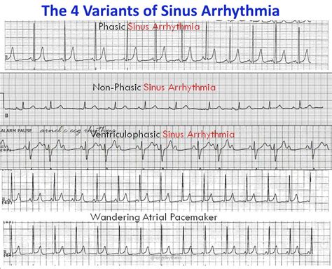 What Causes Sinus Arrhythmia In Dogs