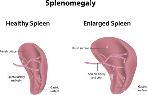 Splenomegaly - MEDizzy