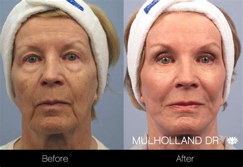 Cheek Lift Surgery (Mid-Facelift) | Toronto Plastic Surgeons