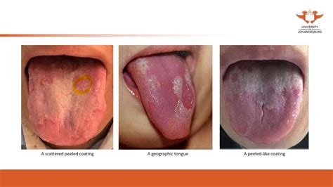 193. UJ online lectures:32 Diagnostics Tongue Diagnosis Tongue Coating ...