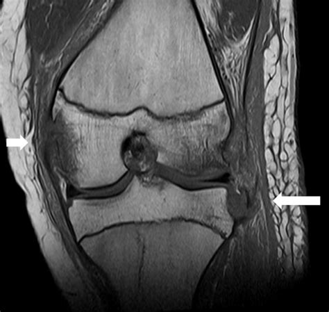 Coronal T1-weighted MRI image shows Segond fracture (arrow) and ...