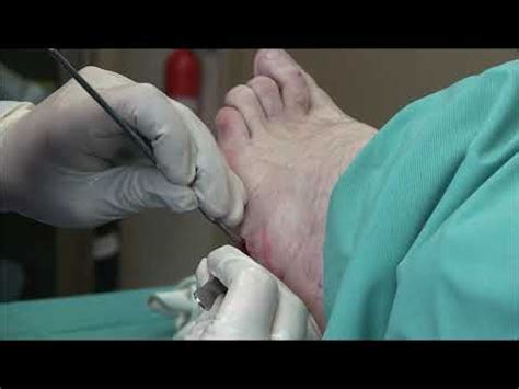 Plantar Fibroma Surgery - YouTube