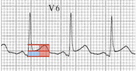 Pericarditis ECG Changes • LITFL • ECG Library Diagnosis