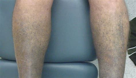 Blue discoloration on both arms and legs - Clinical Advisor