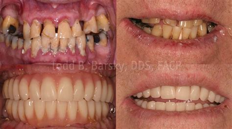 Smile Makeover Patient 15 - Todd B. Barsky, DDS