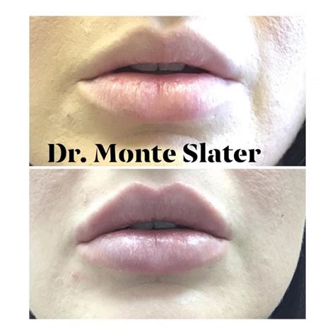 Restylane Kysse Lip Filler Now Available In Atlanta & Warner Robins