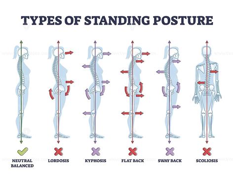 Types of standing postures and medical back pathology set outline diagram. Educational labeled ...