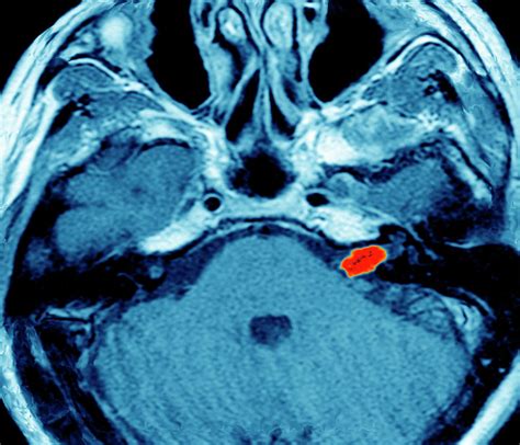 Acoustic Nerve Tumour Photograph by Zephyr/science Photo Library - Pixels