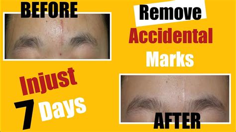 How To Remove Injury Marks On Face At Home | Hand Cut Marks Removal ...