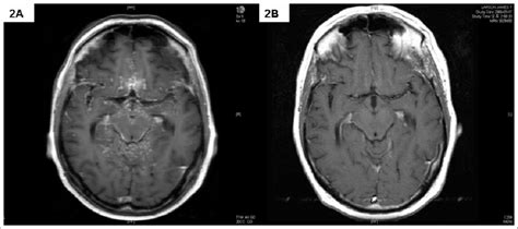 Gadolinium-enhanced T1-weighted axial image of brain MRI showed ...