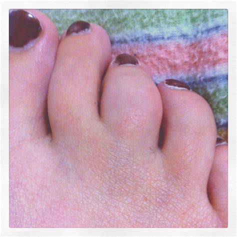 sausage digit (my middle toe) | Middle toe, Toes, Sausage