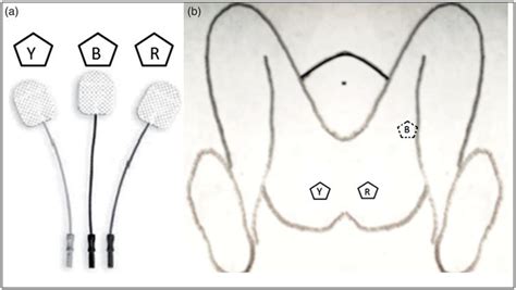 (a) Surface EMG electrodes used in the study; (Y: Yellow, B: Black, R:... | Download Scientific ...