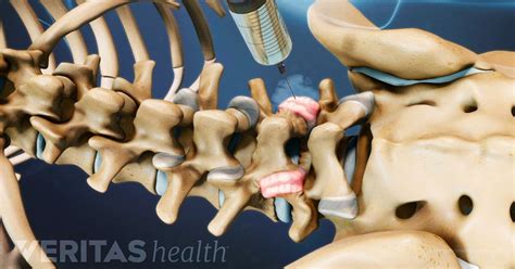 Lumbar Facet Joint Injection Procedure