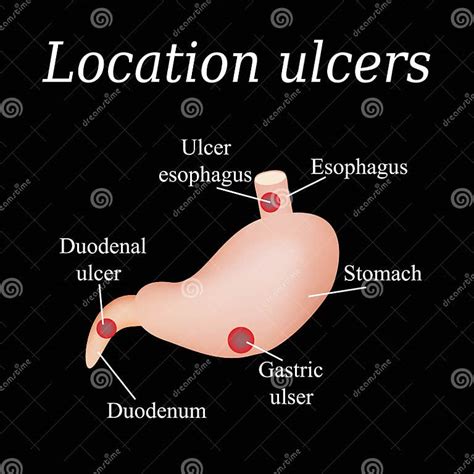 Esophagus Ulcer Affected. Ulcer of Esophagus. Stomach Ulcer Affected. Gastric Ulcer. Duodenum ...