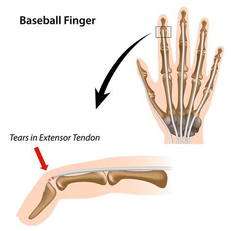 Mallet Finger | Advanced Orthopaedic Specialists | Fayetteville, AR | Rogers, AR