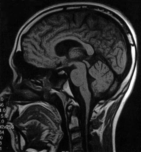 | Midline sagittal MRI scan shows the brain stem and cerebellar vermis ...