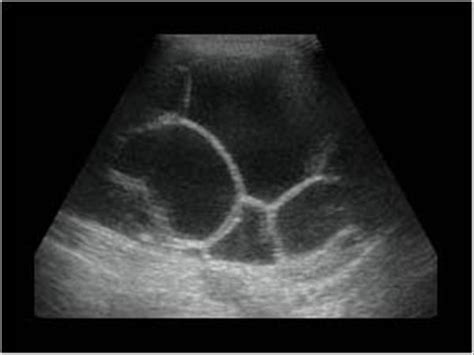 Abdomen and retroperitoneum | 1.1 Liver : Case 1.1.5 Hydatid cysts ...