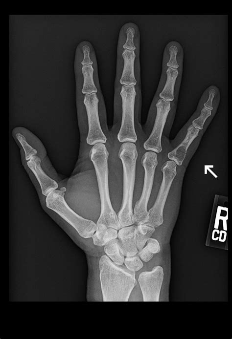 OrthoDx: Injury to Pinky Finger - Clinical Advisor