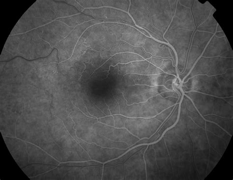 Collateral circulation - American Academy of Ophthalmology