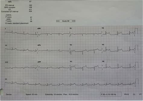 Coronary vasospasm: An infrequent cause of cardiopulmonary arrest | Medicina Intensiva