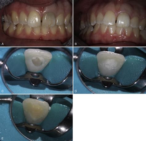 Bleaching Procedures | Pocket Dentistry