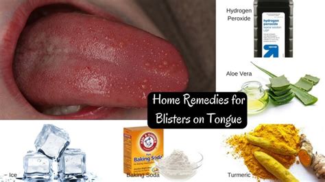 Natural Remedies to Heal Tongue Blisters