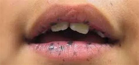 Black Spots on Lips: Pictures, Causes, Get Rid, Home Remedies & Treatment