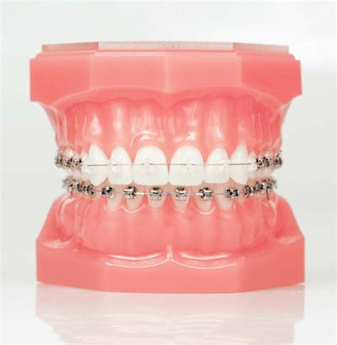 Clear Ceramic Brace Sydney & Ceramic Braces Cost | Smile Concepts