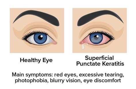 Superficial Punctate Keratitis Spk