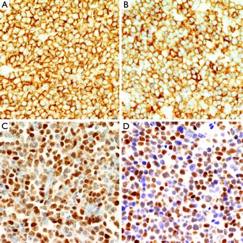 Typical immunophenotypic features of mantle cell lymphoma. (A) Tumor ...