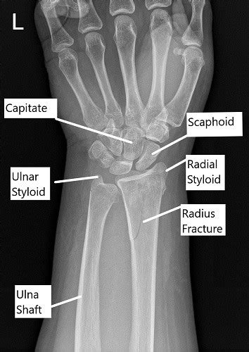 Distal radius fracture - pospoliz